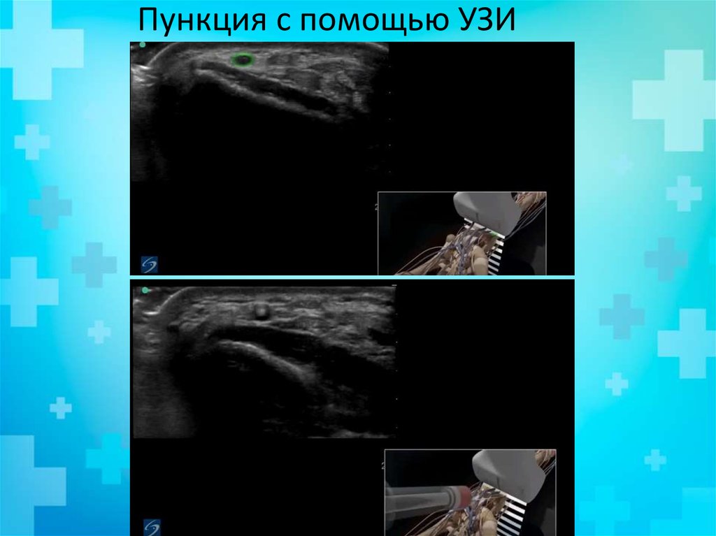 Пункция с помощью УЗИ