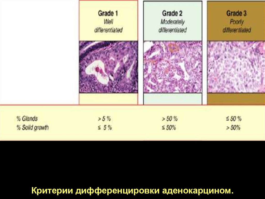 Аденокарцинома low grade. Степени дифференцировки опухоли g1 g2 g3. Степени дифференцировки аденокарциномы. Степень дифференцировки опухоли. Аденокарцинома стадии.