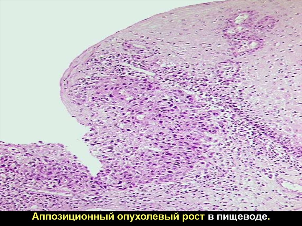 Аппозиционный рост хряща. Аппозиционная опухоль. Инфильтрирующий и аппозиционный рост опухоли. Экспансивный рост опухоли.