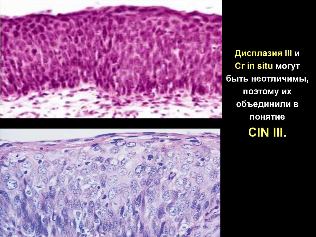 Дисплазия 3 отзывы. Эпителиальные опухоли без специфической локализации.