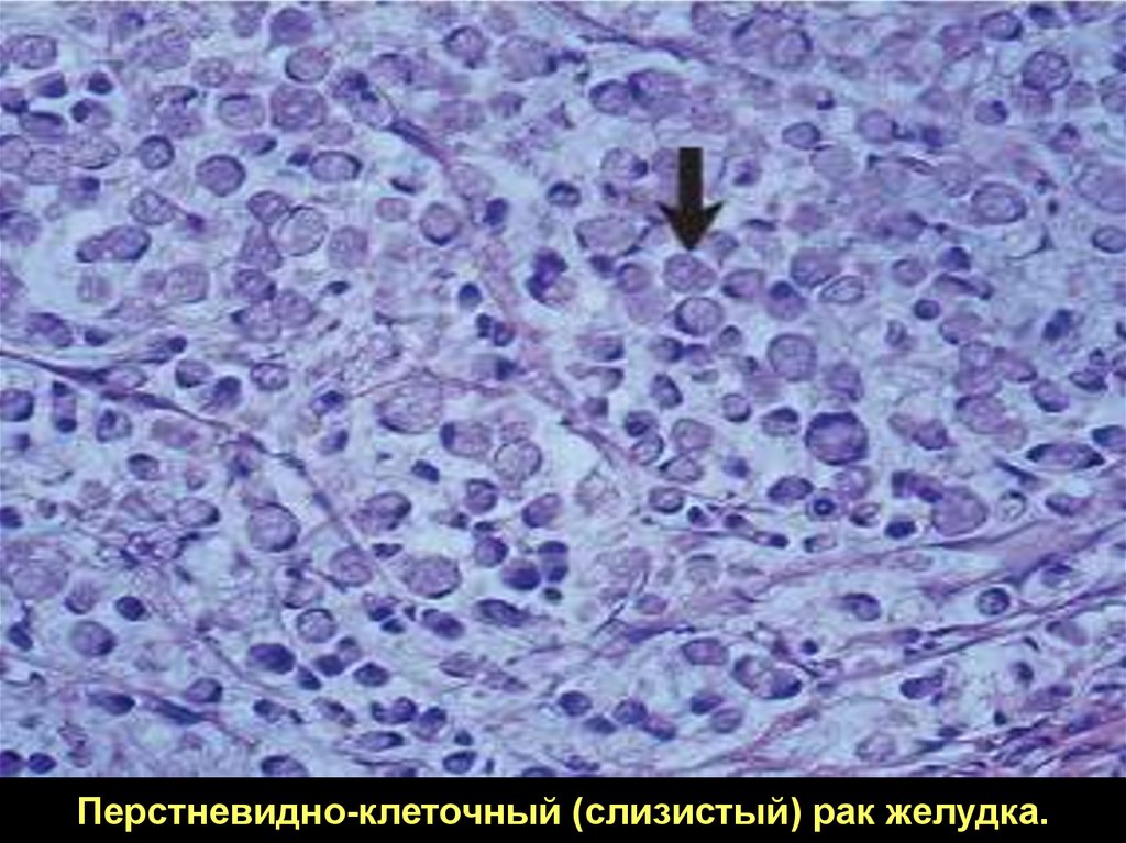 Перстневидно клеточный рак. Перстневидноклеточный(слизистый)рак желудка. Перстевидноклеточная карцинома. Перстневидные клетки микропрепарат.