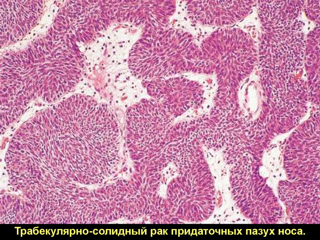 Солидная опухоль это. Трабекулярные структуры опухоли. Трабекулярная аденома гистология. Аденокарцинома трабекулярные структуры. Трабекулярное строение опухоли это.