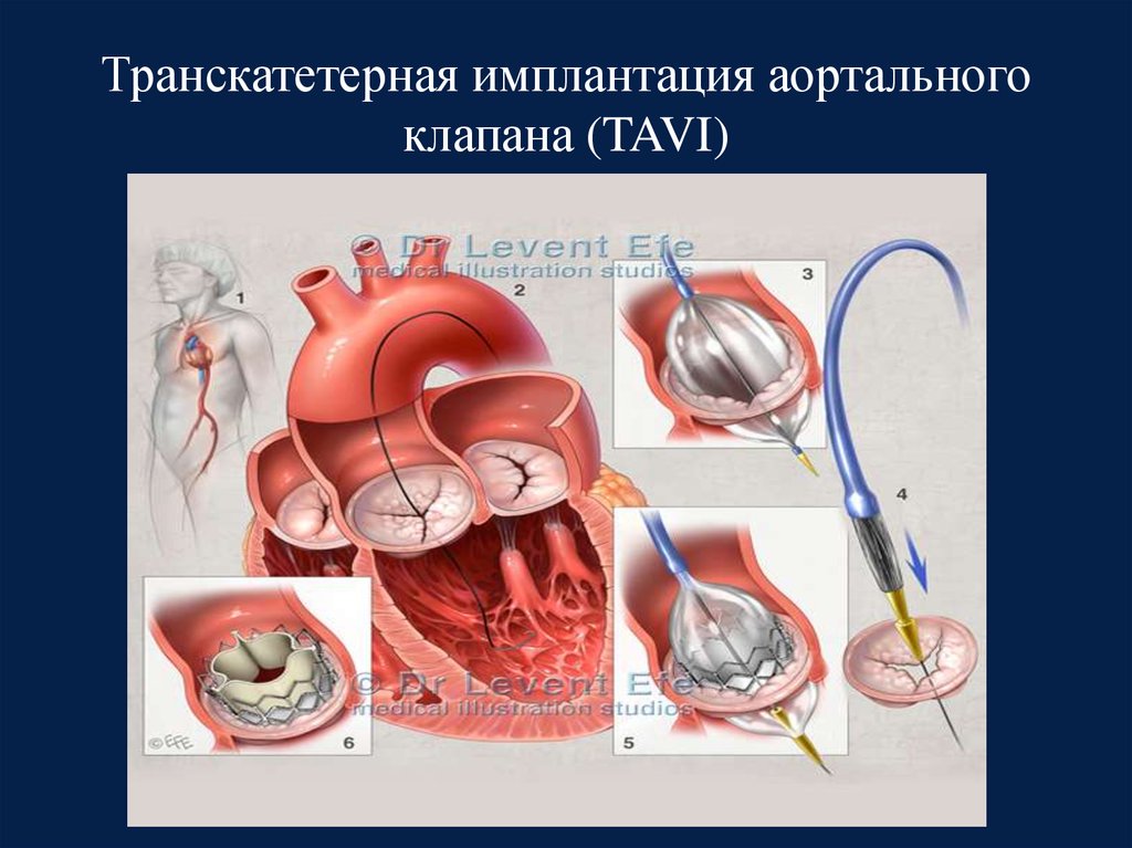 Аортальный клапан картинка