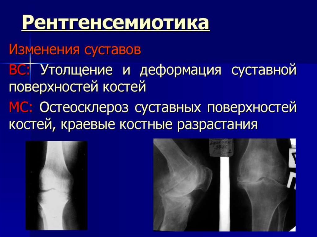 Костно суставной туберкулез презентация