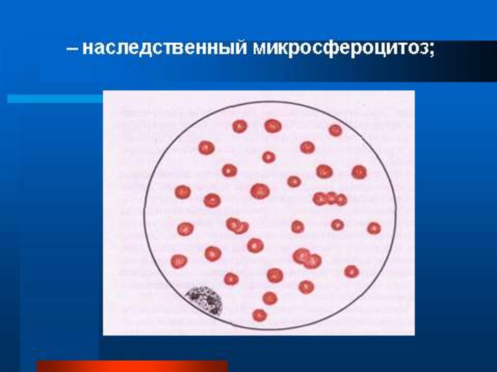 Острая постгеморрагическая анемия картина крови