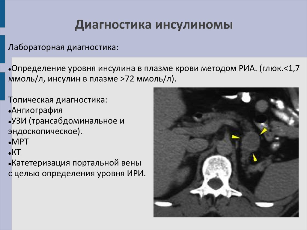 Инсулинома. Инсулинома поджелудочной железы на УЗИ. Инсулинома поджелудочной железы кт. Инсулинома кт признаки. Инсулинома клинические рекомендации.