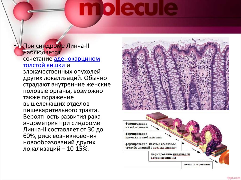 Метастаз аденокарциномы толстой кишки