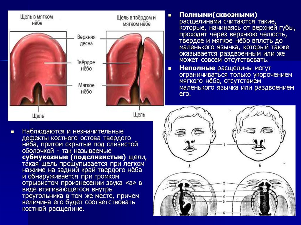 Анализ неба. Ринолалия расщелина неба. Субмукозная расщелина губы. Субмукозная расщелина мягкого неба. Ринолалия расщелина твёрдого неба.