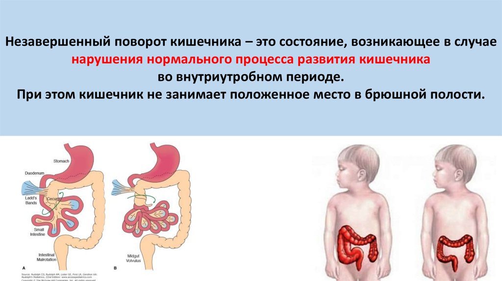 При непроходимости кишечника стул