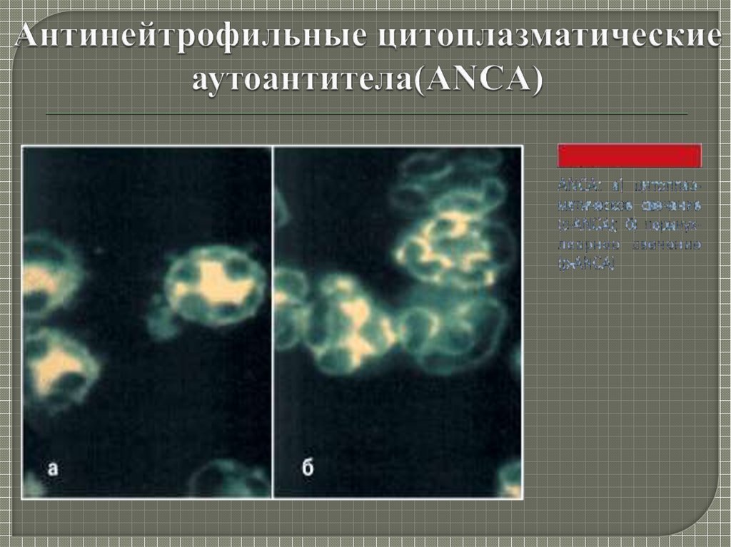 Антинейтрофильные цитоплазматические антитела