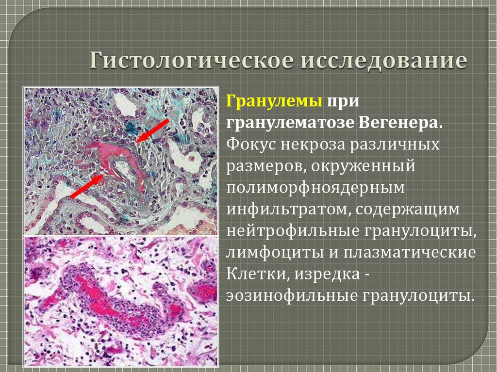 Гранулематоз вегенера картинки