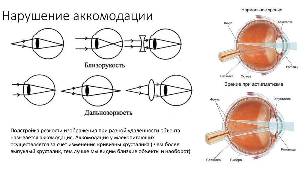 Миопия что это простыми словами. Аккомодация при миопии. Аккомодационный аппарат глаза при миопии и гиперметропии. Нарушения аккомодации зрительного анализатора.. Близорукость и дальнозоркость нарушение аккомодации.