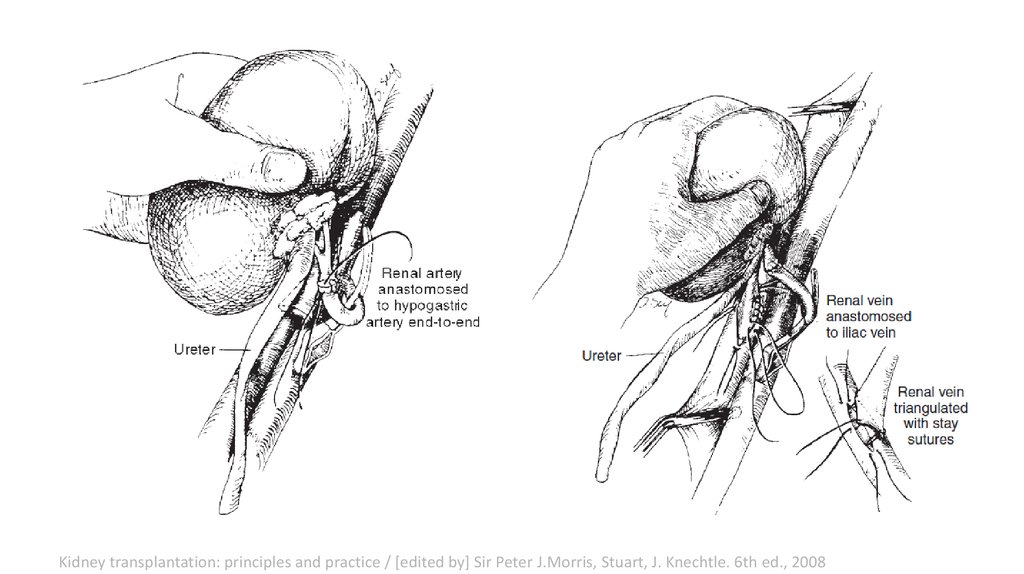 Трансплантация почки схема