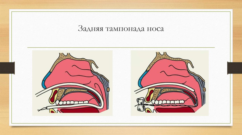 Тампонада носа при кровотечении. Техника передней тампонады носа алгоритм. Передняя и задняя тампонада носа. Набор для задней тампонады носа.