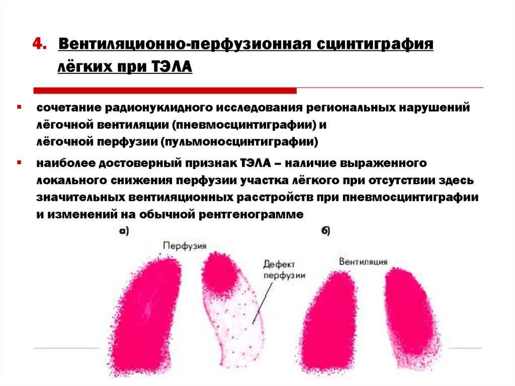 радиоизотопное вентиляционно-перфузионное сканирование легких. вентиляционная сцинтиграфия. сцинтиграфия вентиляционная эмфизема. вентиляционно-перфузионная сцинтиграфия легких. перфузионная сцинтиграфия легких.