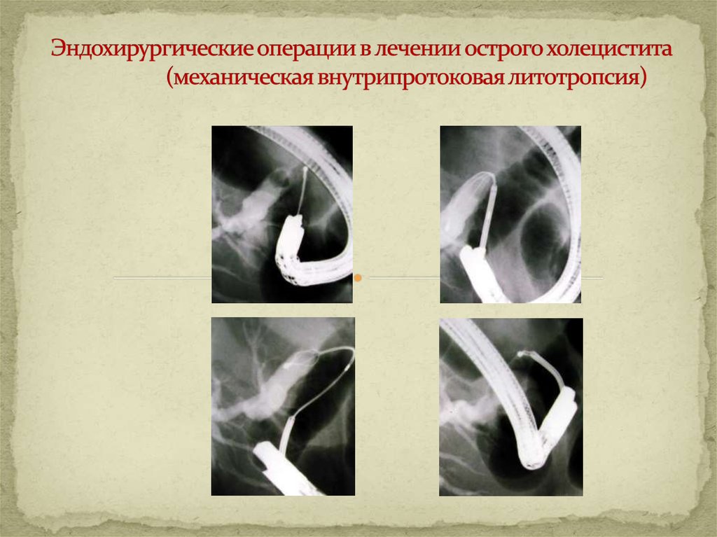 Для эхографической картины острого холецистита характерно тест ответ