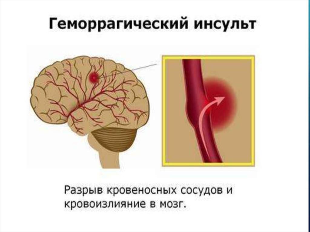 Кровоизлияние ствола мозга. Геморрагический инсульт. Геморрагический нсуль. Инсульт по геморрагическому типу. Геморрагический инсульт кровоизлияние в мозг.