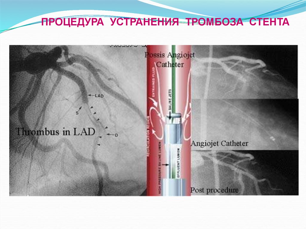 Коронарный тромбоз причина. Тромбоз коронарного стента. Тромбоз стента в коронарной артерии.