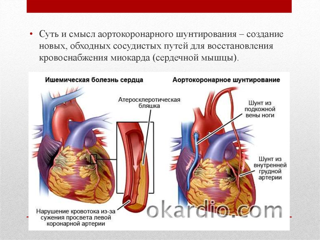 Что такое шунтирование сердца и сосудов. Аортокоронарное шунтирование. Схема аортокоронарного шунтирования. Кровоснабжение миокарда. Аортокоронарное шунтирование с искусственным кровообращением.