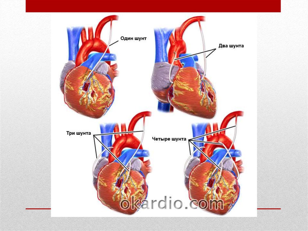 Что такое шунтирование сердца и сосудов. Коронарное шунтирование. Шунтирование сердца фото. Коронарное шунтирование сосудов сердца. Аортокоронарное шунтирование операция.