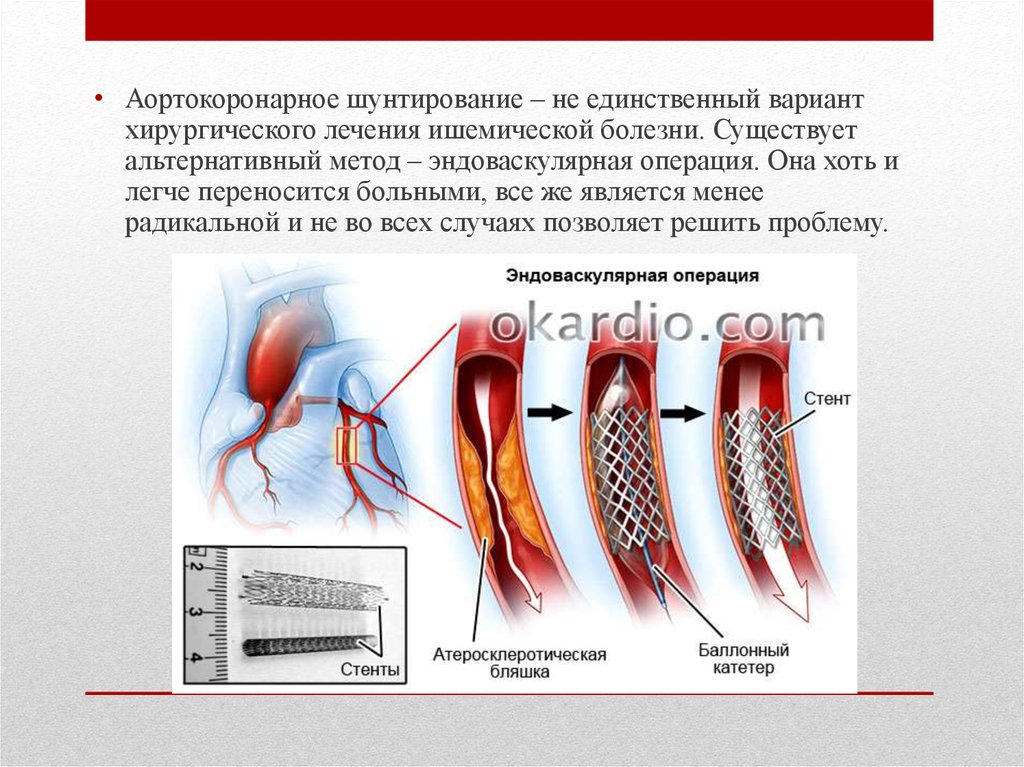 Шунтирование сердце простыми словами операция что такое. Коронарное шунтирование. Аортокоронарного шунтирования.