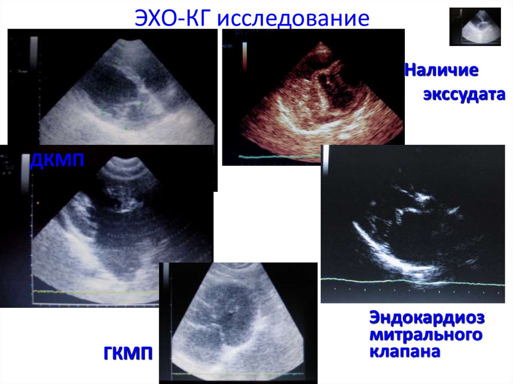 Миксоматозная дегенерация