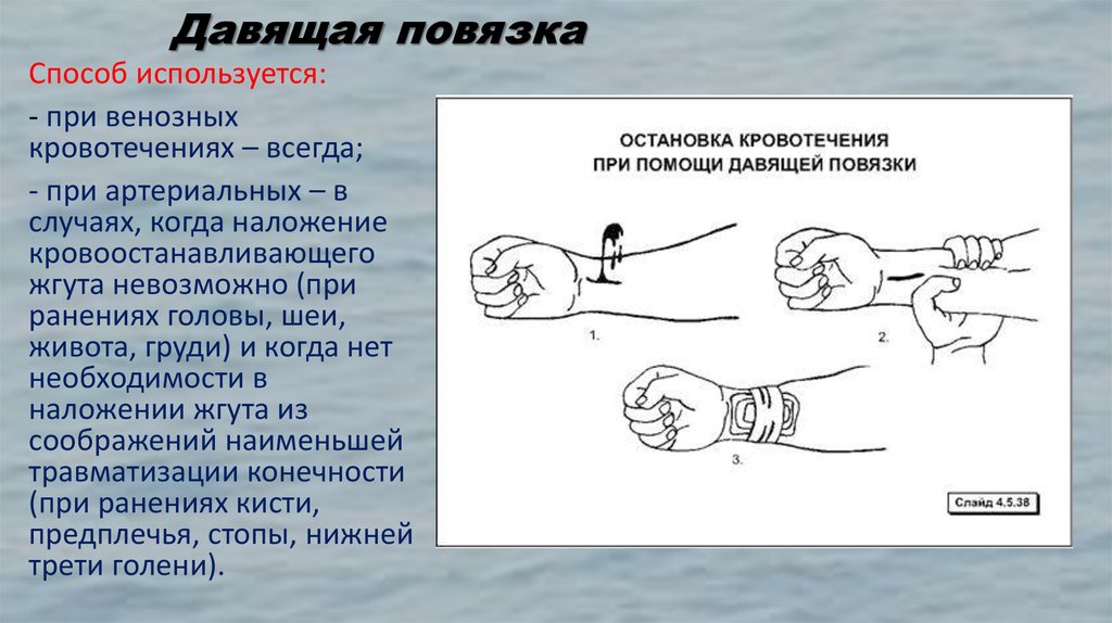 При венозном кровотечении накладывается давящая повязка. Давящей повязки при венозном кровотечении.. Венозное кровотечение наложение давящей повязки.