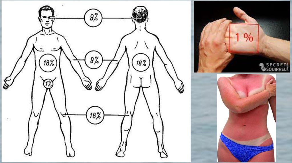 Правило девяток. Схема девяток ожоги. Схема ожогов по процентам. Процент ожогов у взрослых.