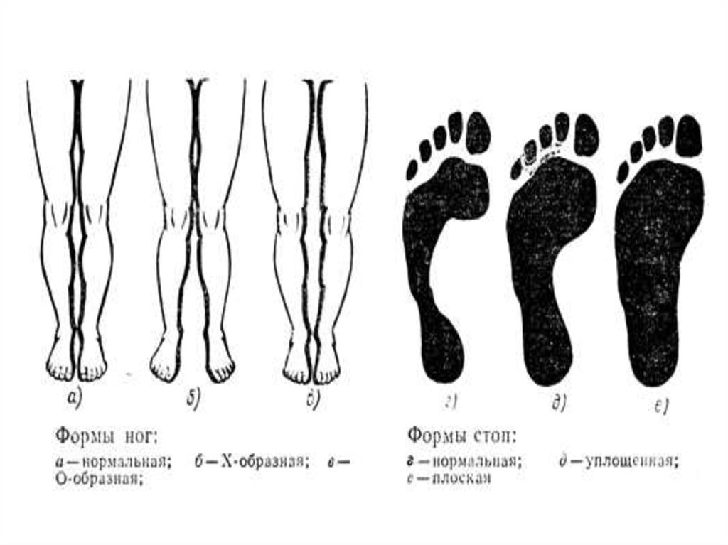 Ноги формой х. Форма ног.