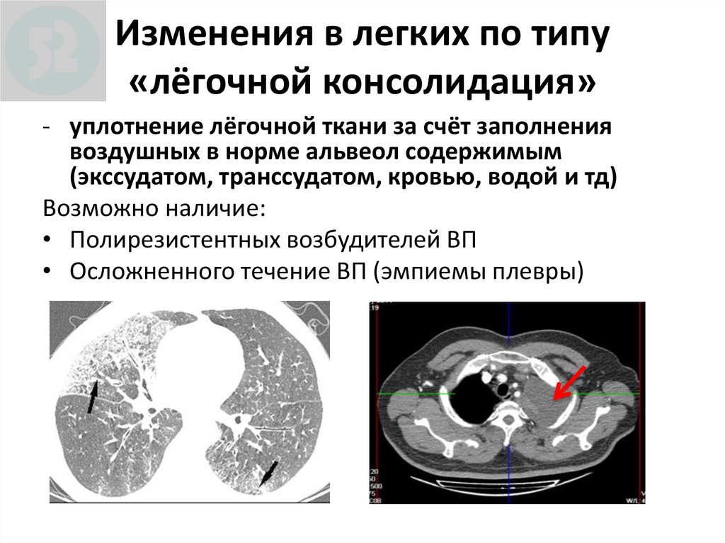 Изменения в легких. Консолидация в легких. Консолидация на кт легких. Консолидация легочной ткани. Участок консолидации легочной ткани на кт.