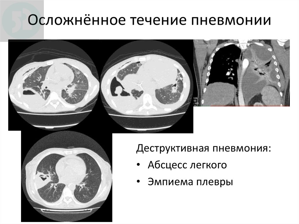 Деструктивная пневмония. Деструктивная пневмония на кт. Двусторонняя деструктивная пневмония кт. Деструктивная пневмония на кт легких.