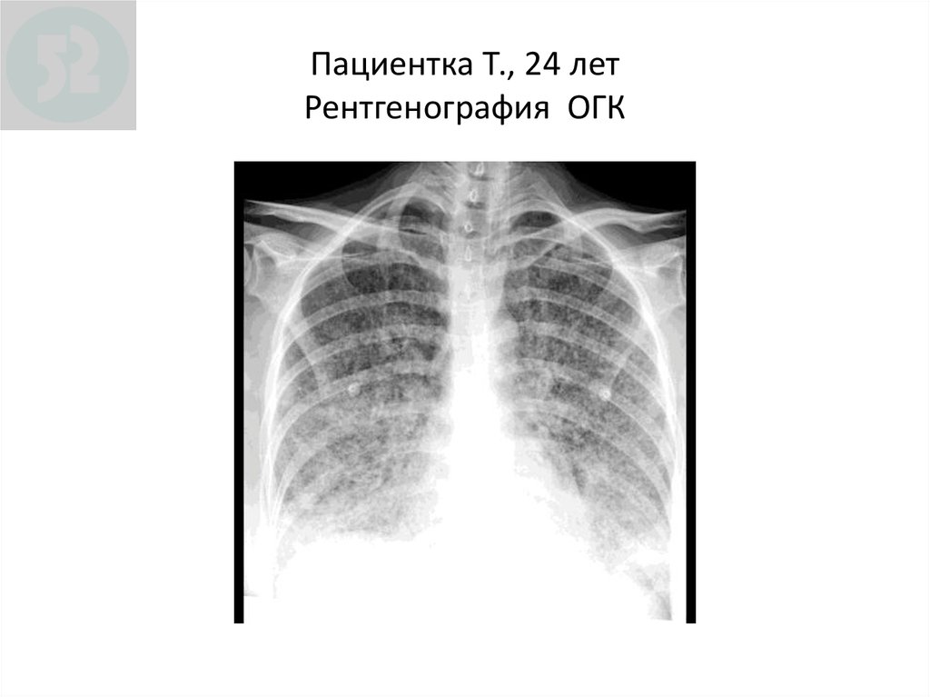 Рентгенография огк. ККФ рентген ОГК. Рентген снимка ОГК В норме. Рентген снимок ОГК В норме. Рентген ОГК норма в 2 -х проекциях.