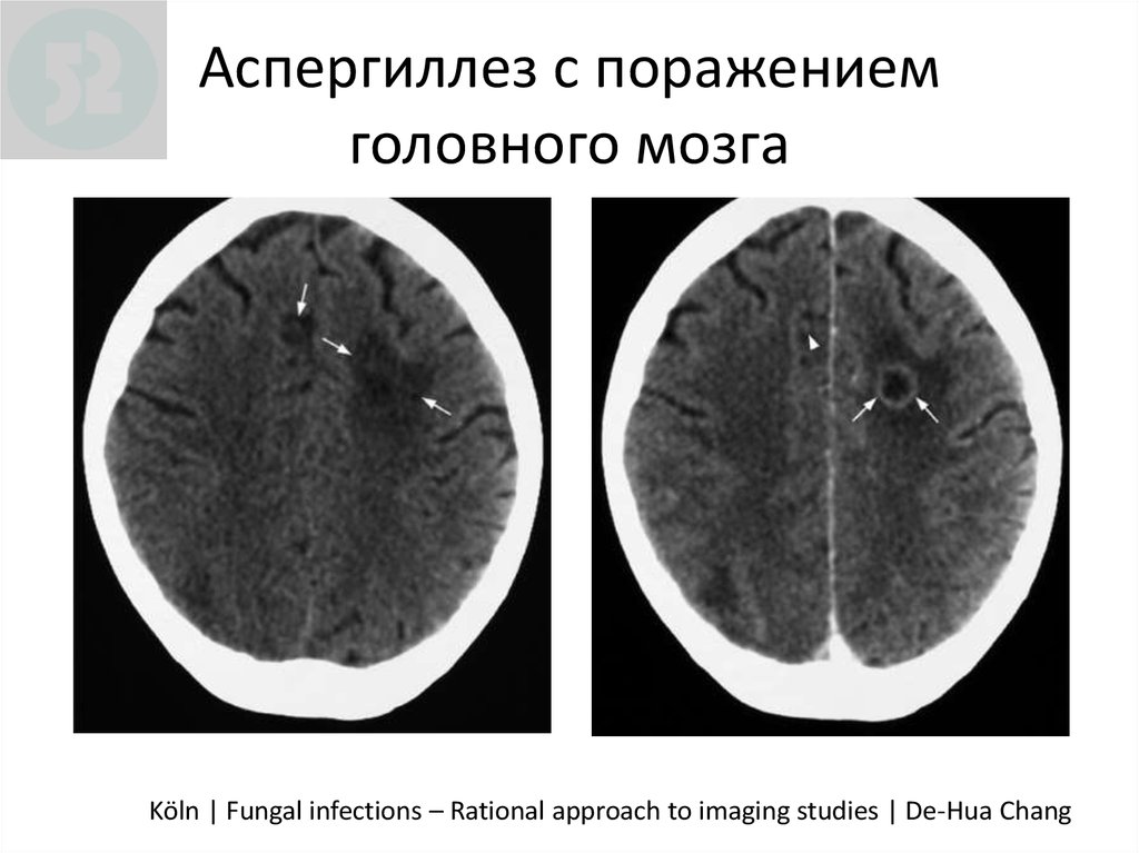 Поражение головней