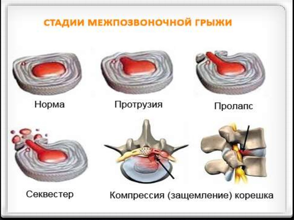 Протрузия что это. Пролапс протрузия экструзия. Этапы формирования грыжи позвоночника. Протрузия дисков позвоночника и грыжа диска. Пролапс поясничного межпозвоночного диска.