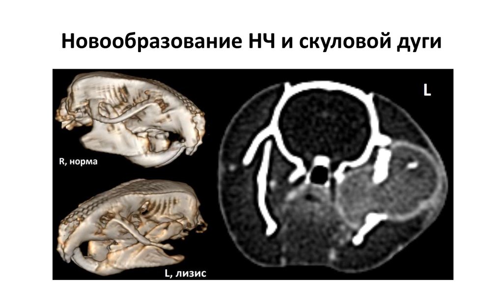 Новообразование НЧ и скуловой дуги