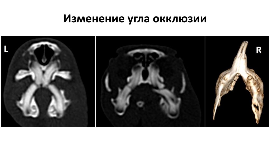 Изменение угла окклюзии
