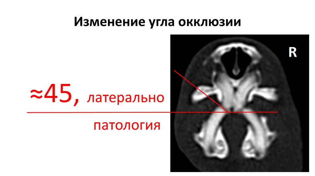 Изменение угла окклюзии