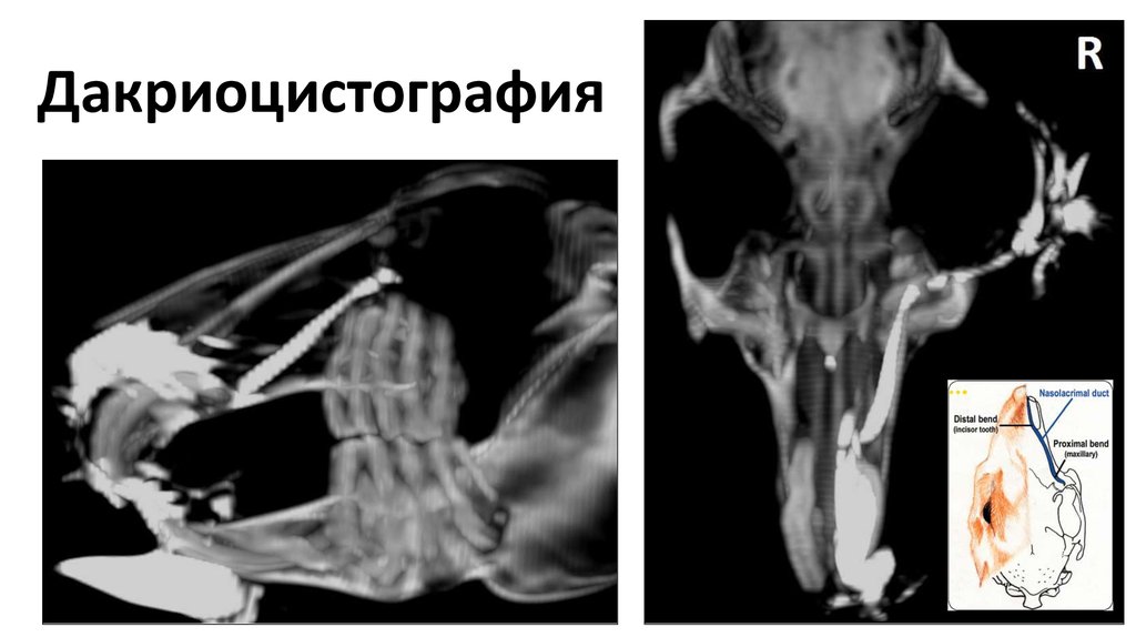 Дакриоцистография