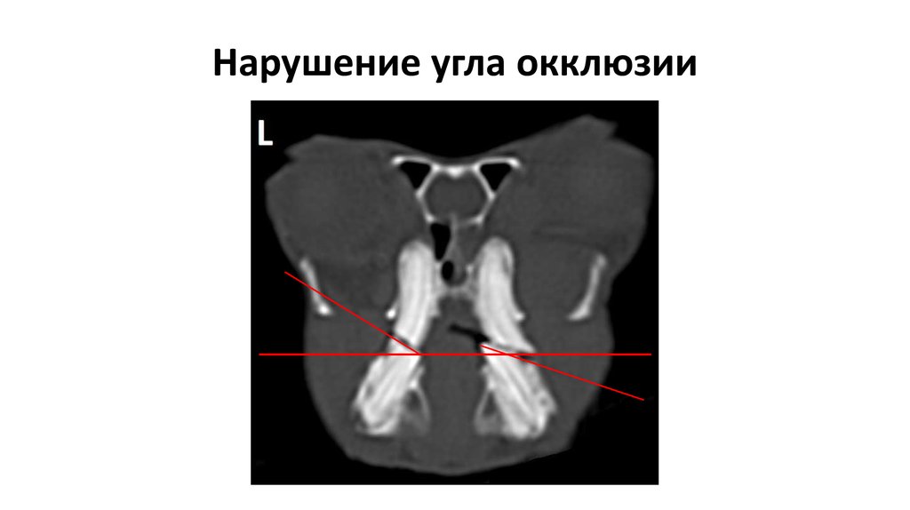 Нарушение угла окклюзии