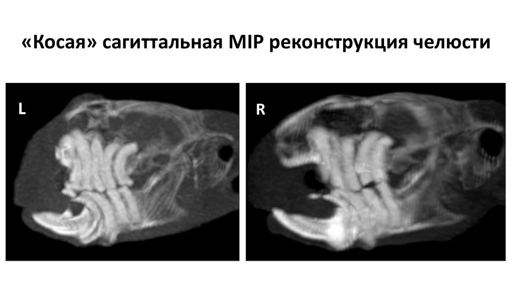 «Косая» сагиттальная MIP реконструкция челюсти
