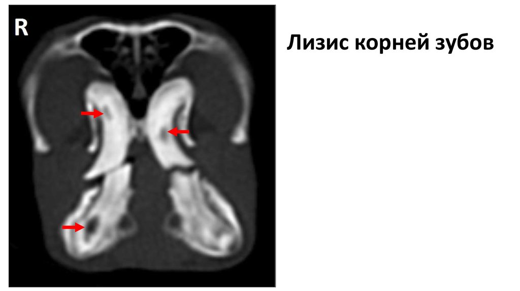Лизис корней зубов
