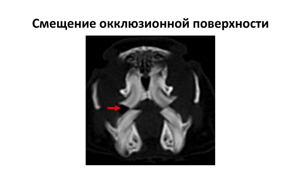Смещение окклюзионной поверхности