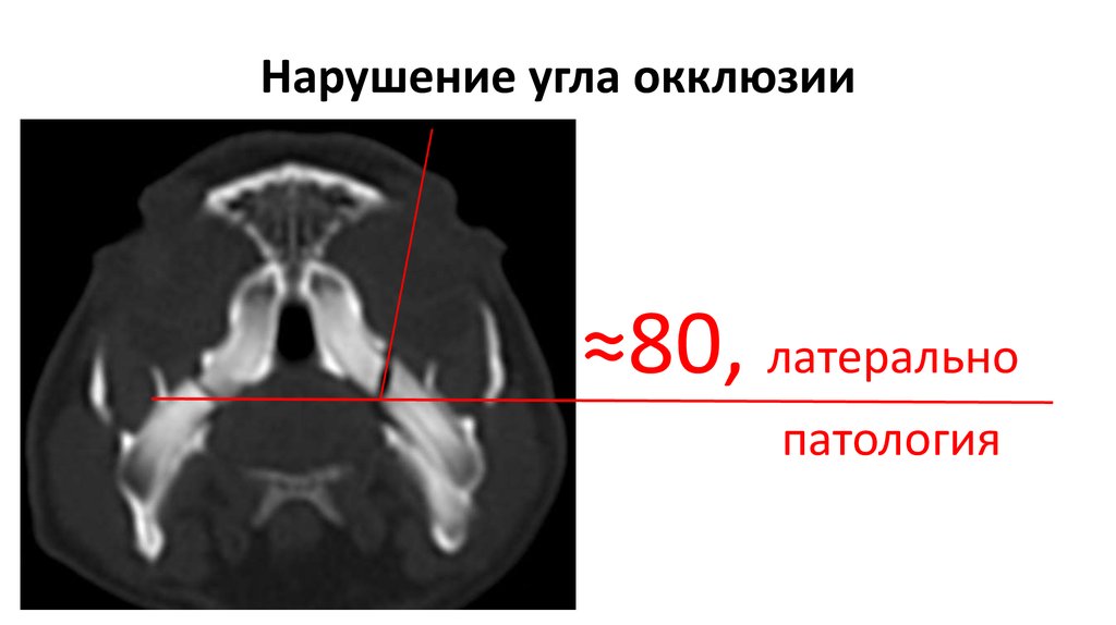 Нарушение угла окклюзии