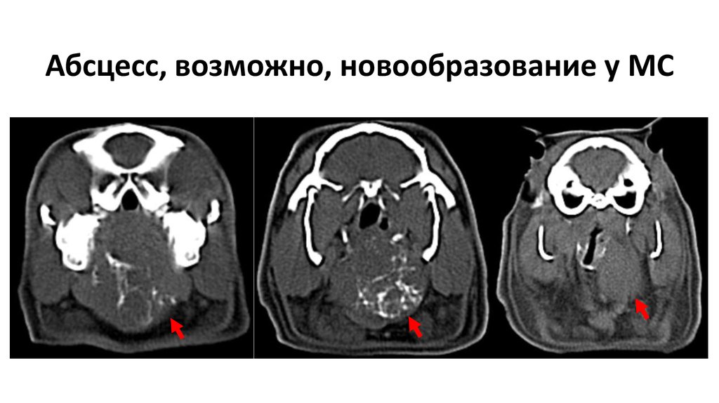 Абсцесс, возможно, новообразование у МС