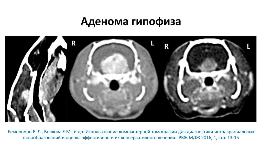 Аденома гипофиза