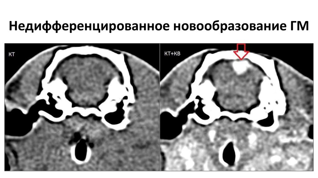 Недифференцированное новообразование ГМ