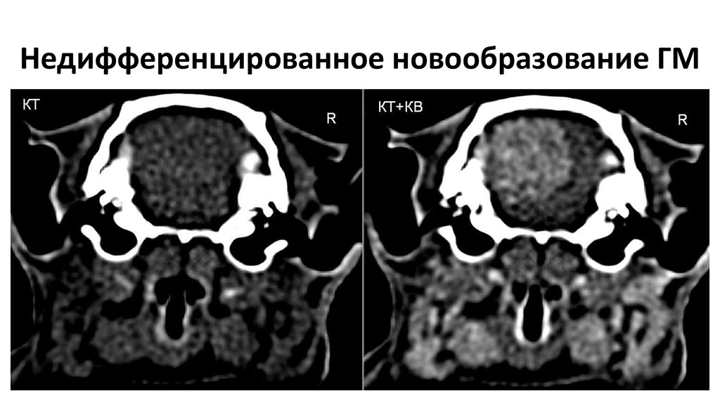 Недифференцированное новообразование ГМ