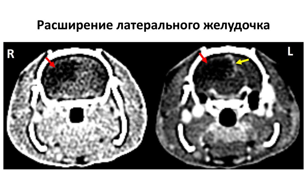 Расширение латерального желудочка