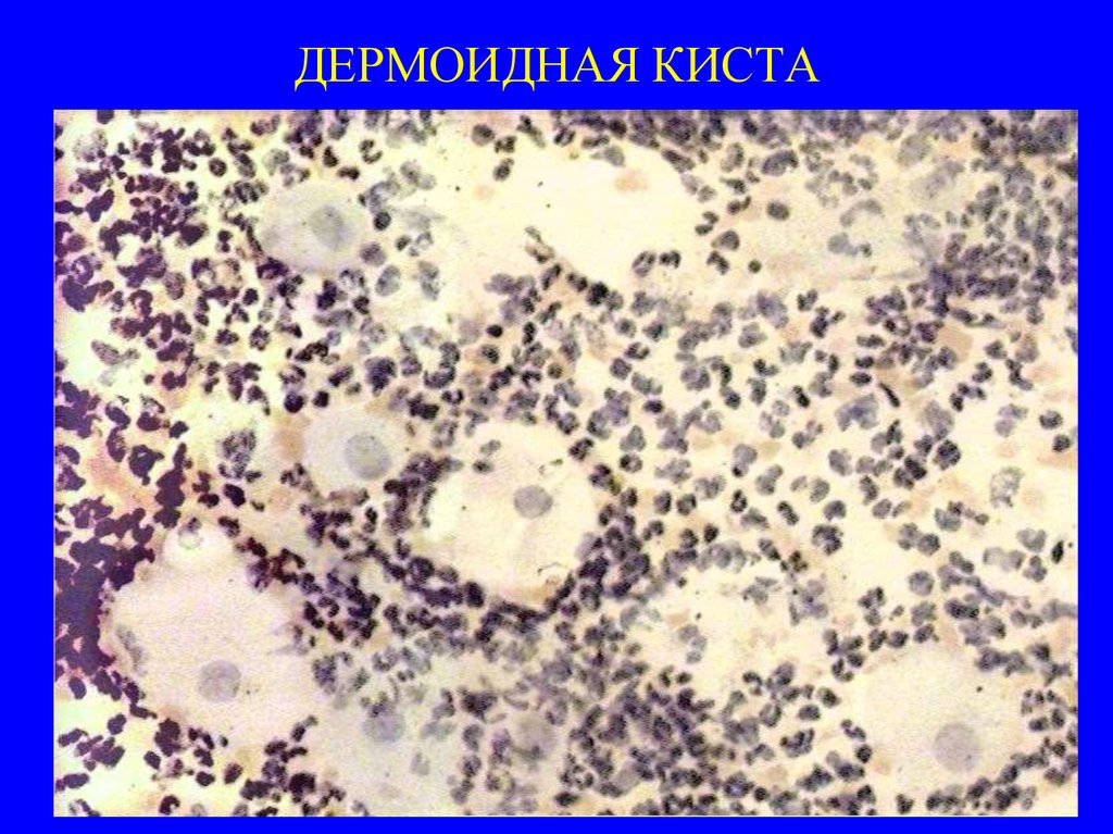 Цитологическая картина содержимого кистозной полости что такое