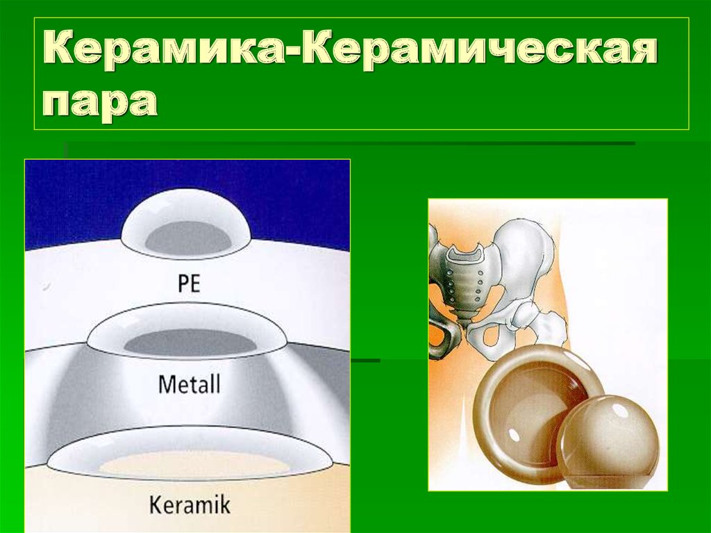 Пара трения. Пары трения керамика-керамика. Керамика полиэтилен пара трения тазобедренного сустава. Пары трения эндопротезов. Керамика керамика пара тазобедренного.